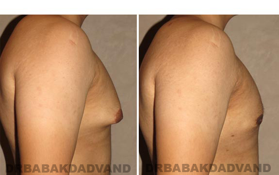 Before and After Photos -Gynecomastia - 23 year old male, -right side view