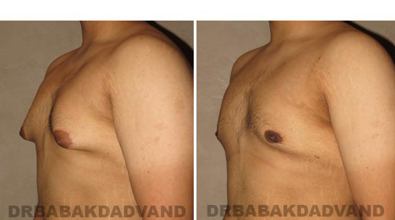 Before and After Photos -Gynecomastia - 23 year old male, -left side, oblique view