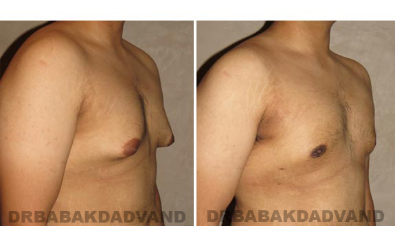 Before and After Photos -Gynecomastia - 23 year old male, -right side, oblique view