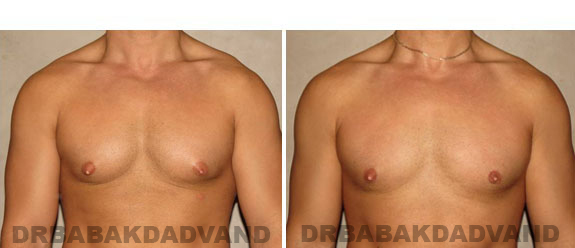Before and After Photos. Breast-Gynecomastia: - 28 year old man, front view