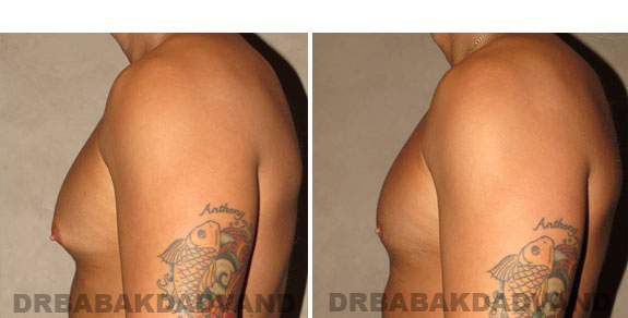 Before and After Photos. Breast-Gynecomastia: - 28 year old man, left side view