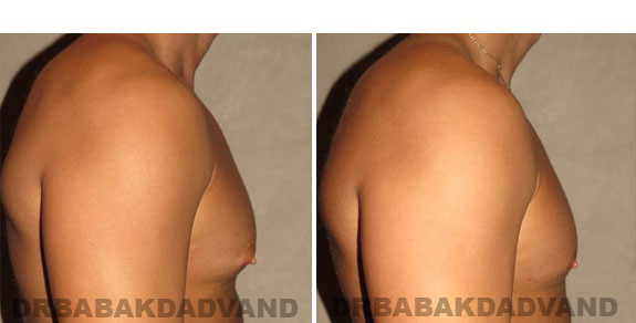 Before and After Photos. Breast-Gynecomastia: - 28 year old man, right side view