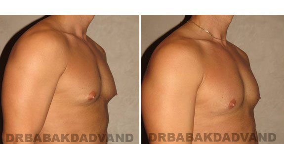 Before and After Photos. Breast-Gynecomastia: - 28 year old man, right side, oblique view