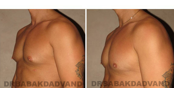 Before and After Photos. Breast-Gynecomastia: - 28 year old man, left side, oblique view