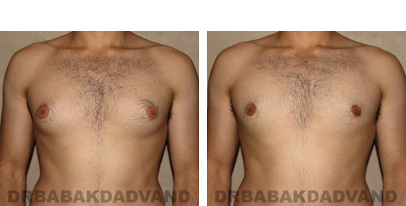 Before and After Photos -Gynecomastia - 22 year old male, - front view