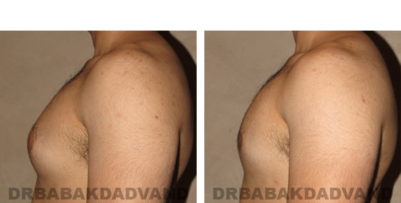 Before and After Photos -Gynecomastia - 22 year old male, -left side view