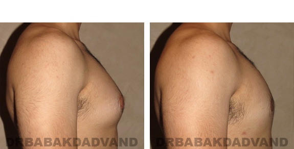 Before and After Photos -Gynecomastia - 22 year old male, -right side view