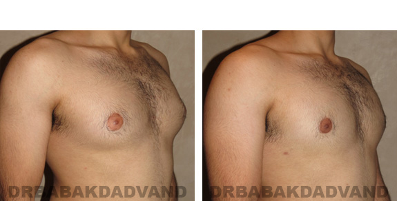Before and After Photos -Gynecomastia - 22 year old male, -right side, oblique view