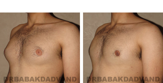 Before and After Photos -Gynecomastia - 22 year old male, -left side, oblique view