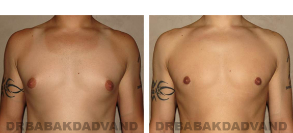 Before and After Photos |Gynecomastia| 27 year old male, - front view