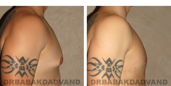 Before and After Photos |Gynecomastia| 27 year old male, - right side view