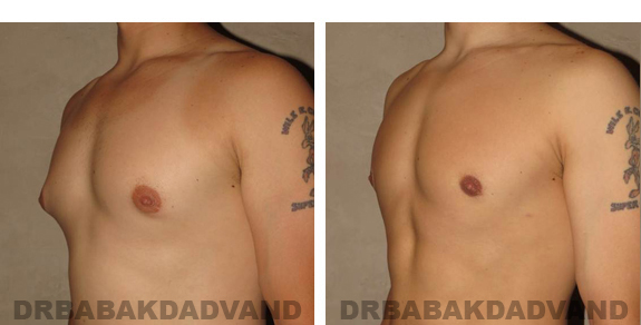 Before and After Photos |Gynecomastia| 27 year old male, - left side, oblique view