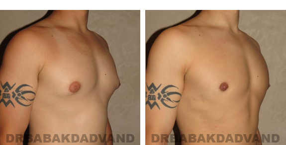 Before and After Photos |Gynecomastia| 27 year old male, - right side, oblique view