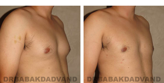 Before and After Photos |Gynecomastia| 27 year old man, - right side, oblique view