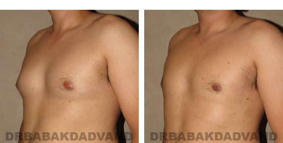 Before and After Photos |Gynecomastia| 27 year old man, - left side, oblique view