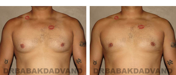 Before and After Photos |Gynecomastia| 34 year old man, - front view