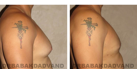 Before and After Photos |Gynecomastia| 34 year old man, - right side view