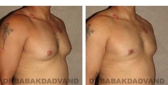 Before and After Photos |Gynecomastia| 34 year old man, - right side, oblique view