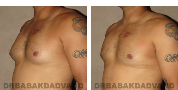 Before and After Photos |Gynecomastia| 34 year old man, - left side, oblique view