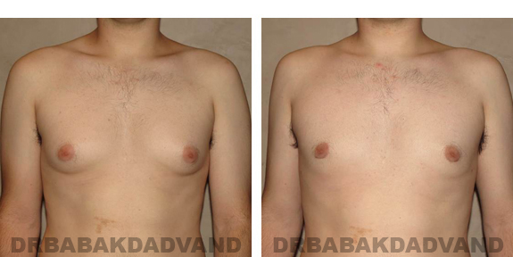 Before and After Photos |Gynecomastia| 24 year old man, - front view