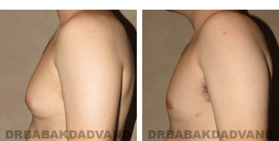 Before and After Photos |Gynecomastia| 24 year old man, - left side view