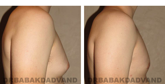 Before and After Photos |Gynecomastia| 24 year old man, - right side view