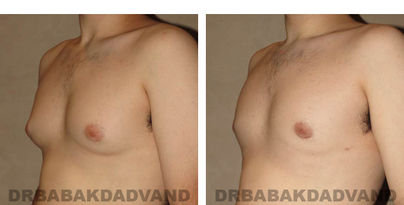Before and After Photos |Gynecomastia| 24 year old man, - left side, oblique view