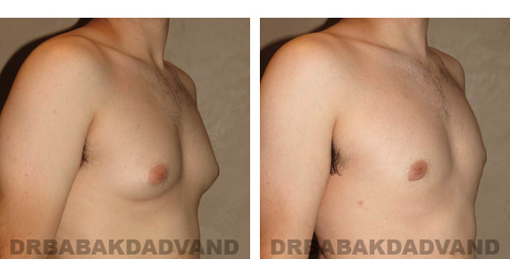 Before and After Photos |Gynecomastia| 24 year old man, - right side, oblique view