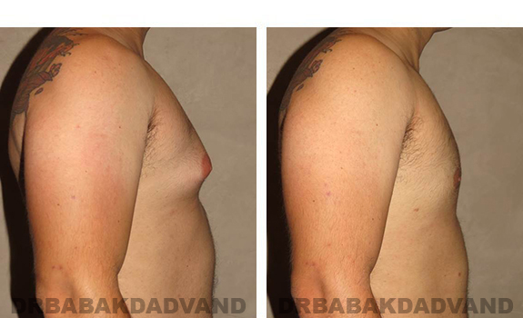 Before and After Photos. Breast-Gynecomastia: - 27 year old male, right side view