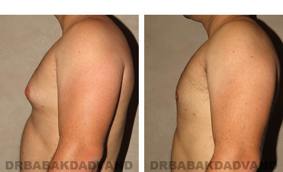 Before and After Photos. Breast-Gynecomastia: - 27 year old male, left side view