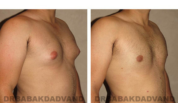 Before and After Photos. Breast-Gynecomastia: - 27 year old male, right side, oblique view