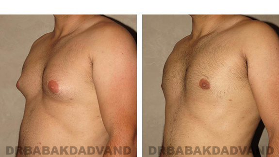 Before and After Photos. Breast-Gynecomastia: - 27 year old male, left side, oblique view