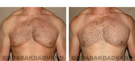 Before and After Photos. Breast-Gynecomastia: - 39 year old man, front view