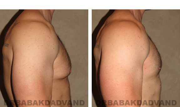 Before and After Photos. Breast-Gynecomastia: - 39 year old man, right side view