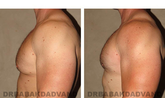 Before and After Photos. Breast-Gynecomastia: - 39 year old man, left side view