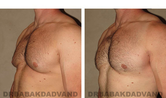 Before and After Photos. Breast-Gynecomastia: - 39 year old man, left side, oblique view