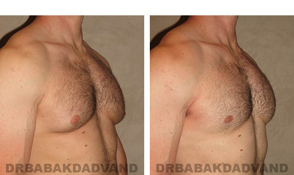 Before and After Photos. Breast-Gynecomastia: - 39 year old man, right side, oblique view