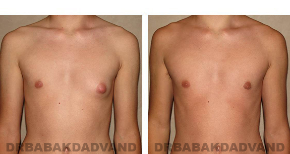 Before and After Photos. Breast-Gynecomastia: - 16 year old man, front view