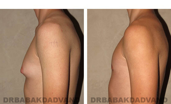 Before and After Photos. Breast-Gynecomastia: - 16 year old man, left side view