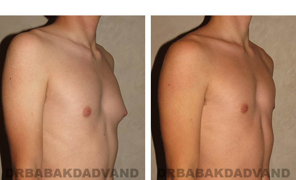 Before and After Photos. Breast-Gynecomastia: - 16 year old man, right side, oblique view