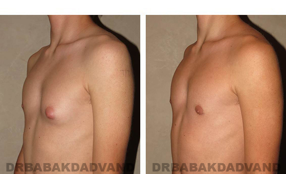 Before and After Photos. Breast-Gynecomastia: - 16 year old man, left side, oblique view