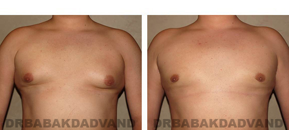 Before and After Photos. Breast-Gynecomastia: - 21 year old male, front view
