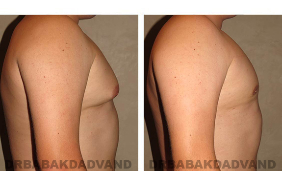 Before and After Photos. Breast-Gynecomastia: - 21 year old male, right side view
