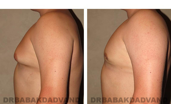 Before and After Photos. Breast-Gynecomastia: - 21 year old male, left side view