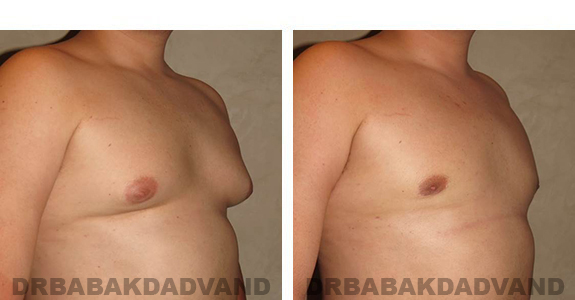 Before and After Photos. Breast-Gynecomastia: - 21 year old male, right side, oblique view