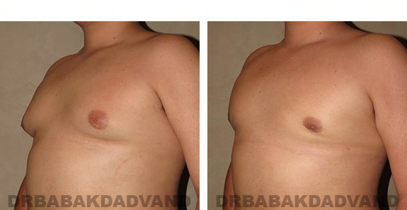 Before and After Photos. Breast-Gynecomastia: - 21 year old male, left side, oblique view