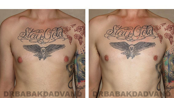 Before and After Photos |Gynecomastia| - 28 year old man, - front view