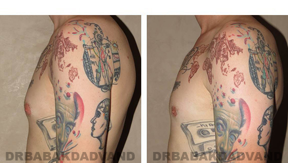 Before and After Photos |Gynecomastia| - 28 year old man, - left side view