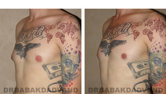 Before and After Photos |Gynecomastia| - 28 year old man, - left side, oblique view