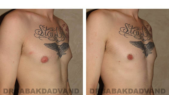 Before and After Photos |Gynecomastia| - 28 year old man, - right side, oblique view